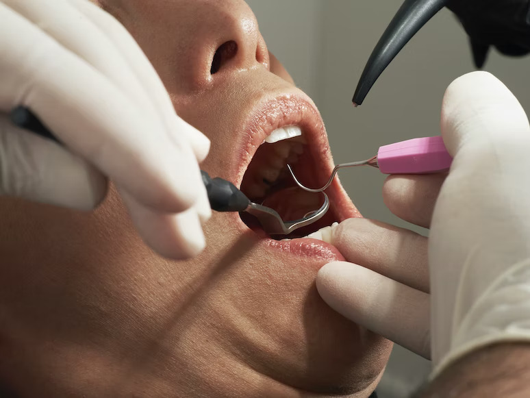 Dental Checkup in Noida